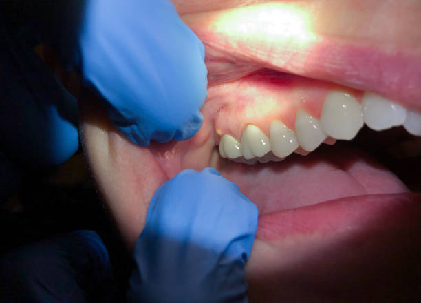 Best Emergency Tooth Extraction in Risg Sun, IN